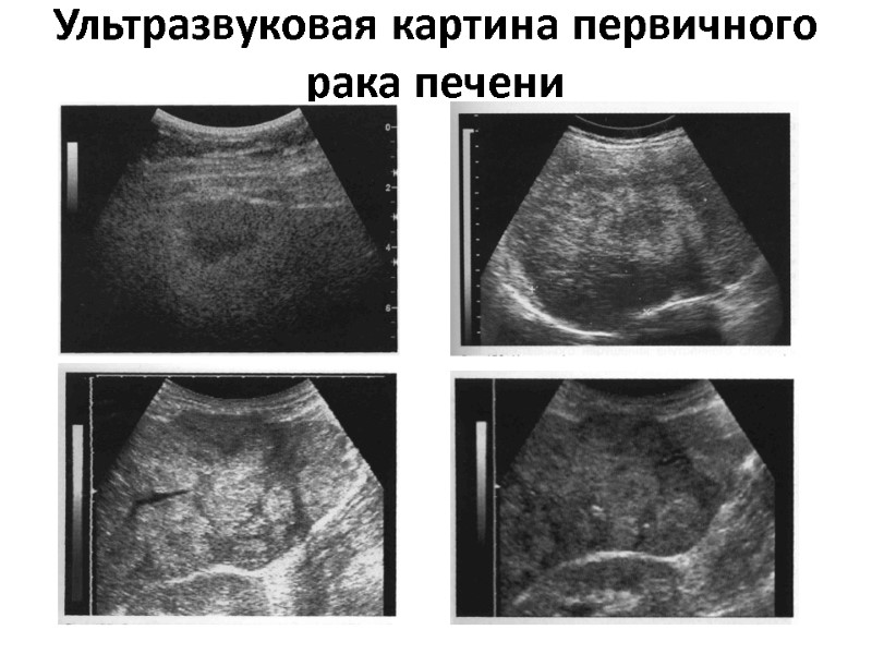 Ультразвуковая картина первичного рака печени